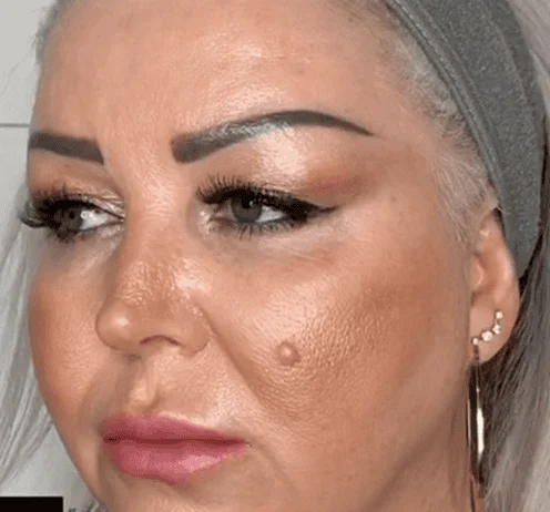 Before: face
