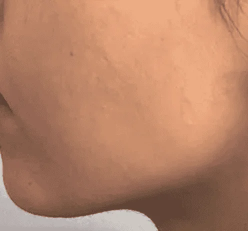 After: jawline