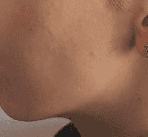 Before: jawline