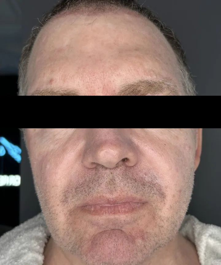 Before: morpheus8