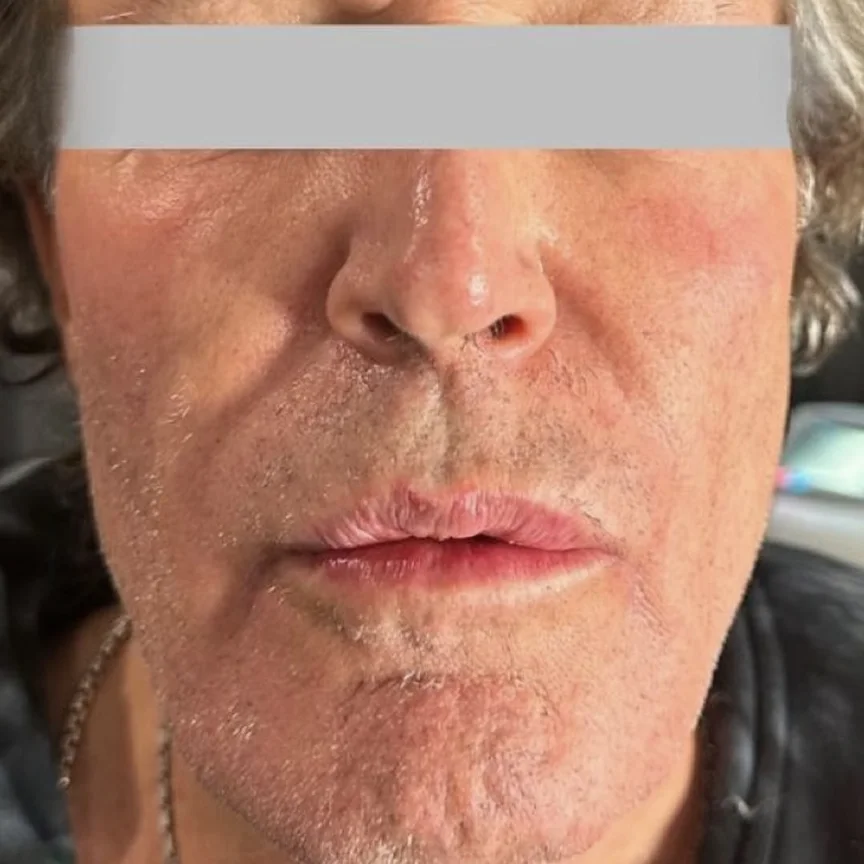 Before: morpheus8