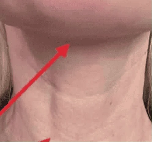 After: neck