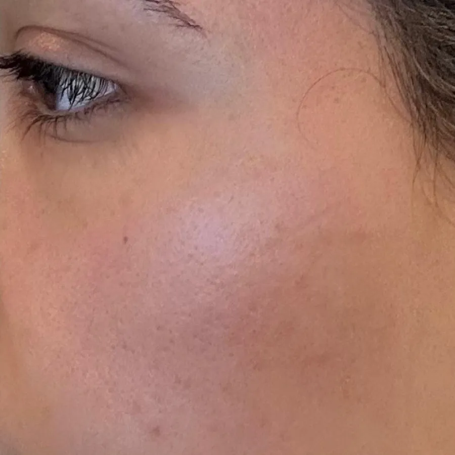 After: microneedling