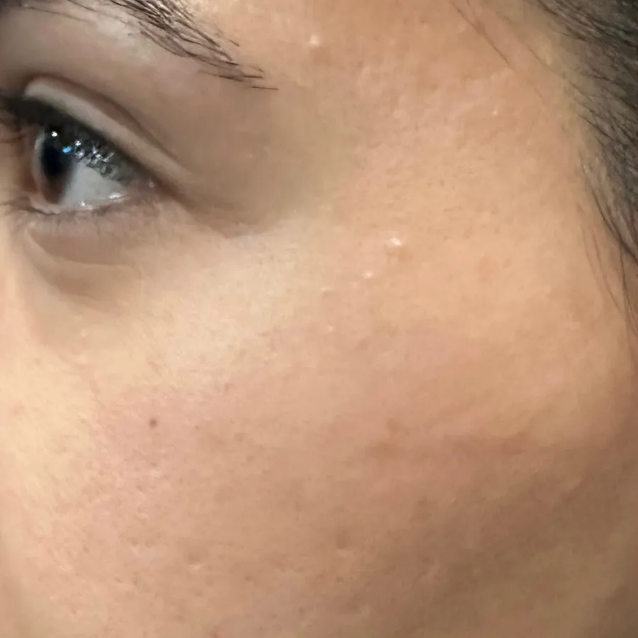 Before: microneedling