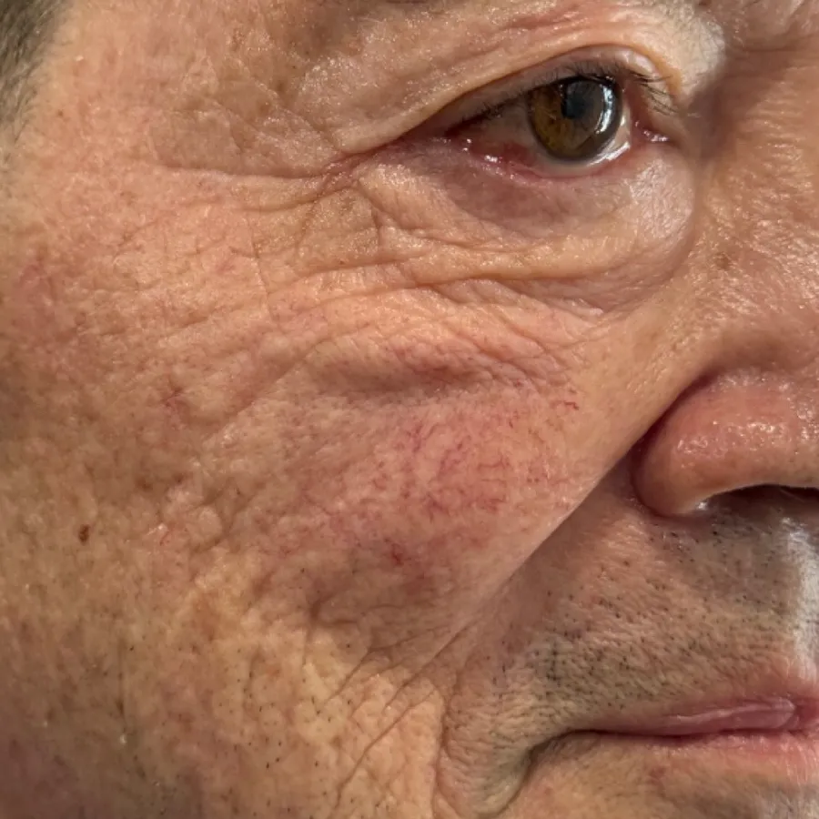 Before: morpheus8