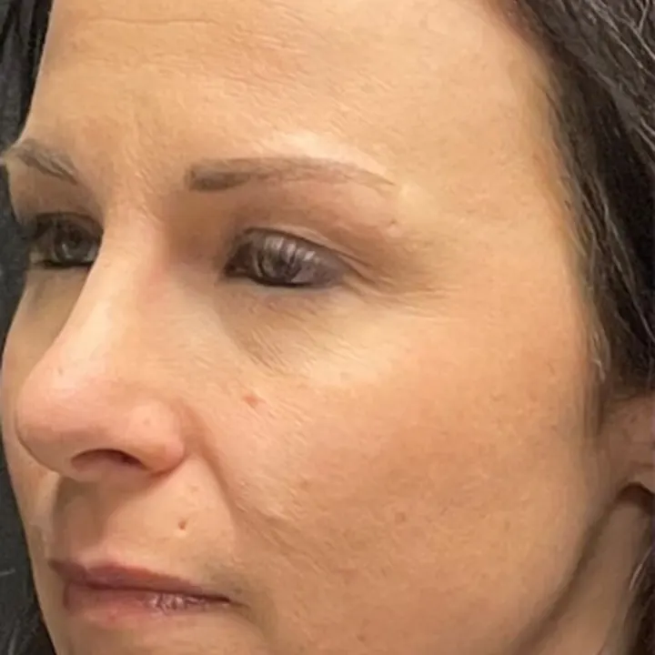 After: rhinoplasty