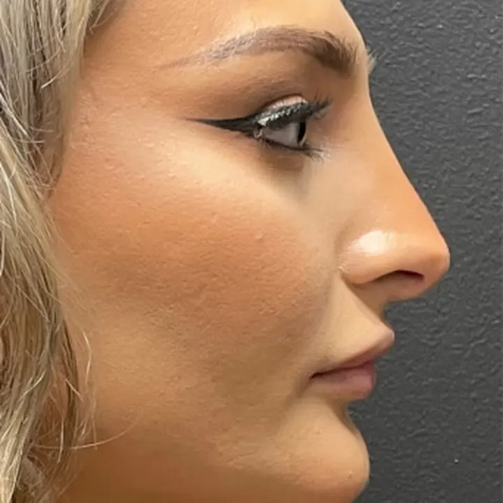 After: rhinoplasty