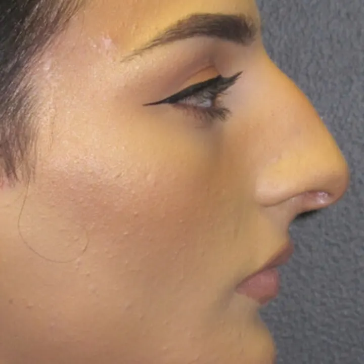 Before: rhinoplasty