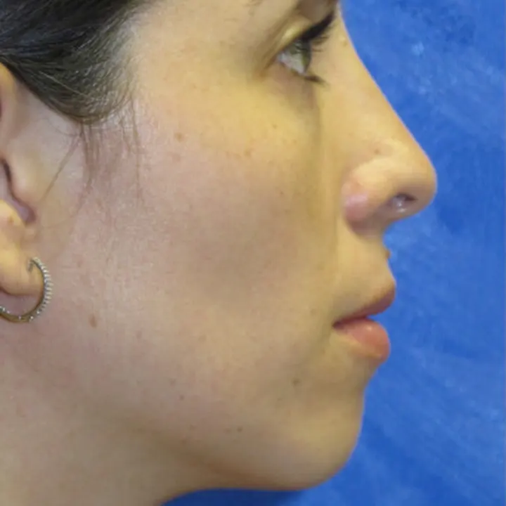 After: rhinoplasty