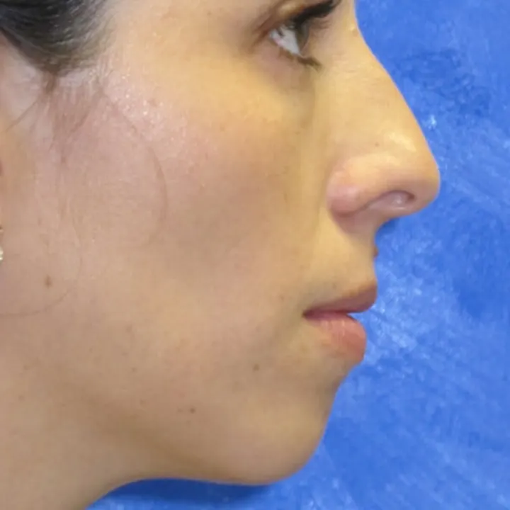 Before: rhinoplasty