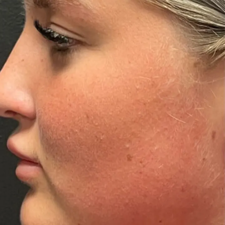 After: rhinoplasty