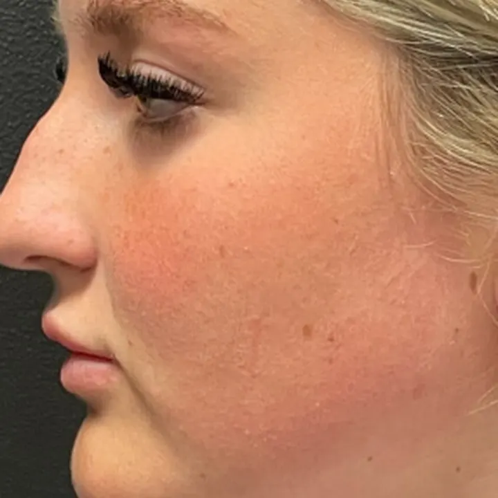 Before: rhinoplasty