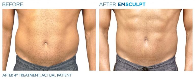 Emsculpt Before And After Man 768x314 1