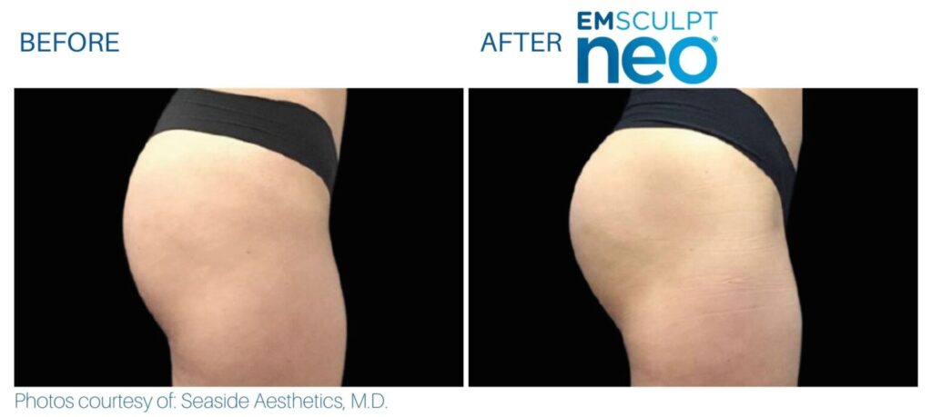 Emsculpt Neo Spa West Westlake Ohio Before And After 1 1536x688 1